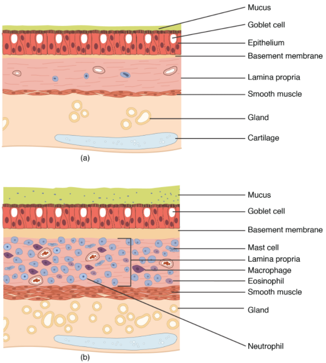 Figure 8.1.11. Normal and bronchial asthma tissues. (a) Normal lung tissue does not have the characteristics of lung tissue during (b) an asthma attack, which include thickened mucosa, increased mucus-producing goblet cells, and eosinophil infiltrates.