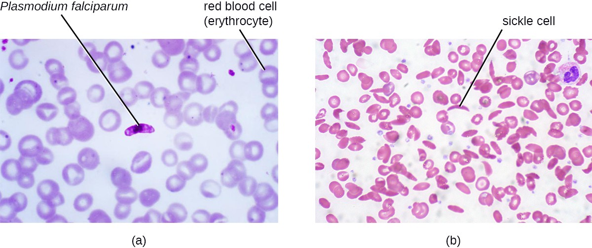 Blood smears showing two diseases of the blood. (a) Malaria is an infectious, zoonotic disease caused by the protozoan pathogen Plasmodium falciparum (shown here) and several other species of the genus Plasmodium. It is transmitted by mosquitoes to humans. (b) Sickle cell disease is a noninfectious genetic disorder that results in abnormally shaped red blood cells, which can stick together and obstruct the flow of blood through the circulatory system. It is not caused by a pathogen, but rather a genetic mutation.