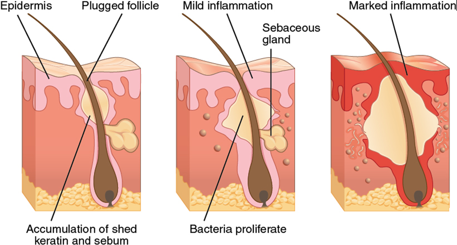 Diagram of acne production process