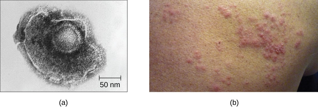 (a) Varicella-zoster, the virus that causes chickenpox, has an enveloped icosahedral capsid visible in this transmission electron micrograph. Its double-stranded DNA genome becomes incorporated in the host DNA. (b) After a period of latency, the virus can reactivate in the form of shingles, usually manifesting as a painful, localized rash on one side of the body.