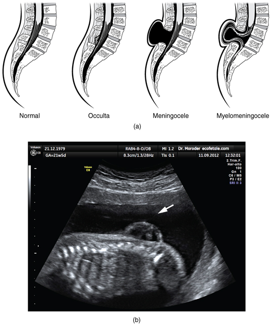 Spinal bifida
