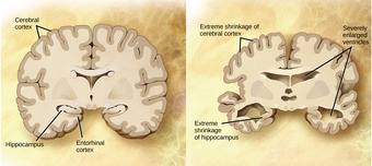 Alzheimer's disease