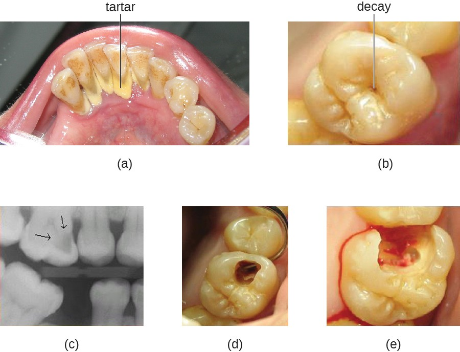 (a) Tartar (dental calculus) is visible at the bases of these teeth. The darker deposits higher on the crowns are staining. (b) This tooth shows only a small amount of visible decay. (c) An X-ray of the same tooth shows that there is a dark area representing more decay inside the tooth. (d) Removal of a portion of the crown reveals the area of damage. (e) All of the cavity must be removed before filling.
