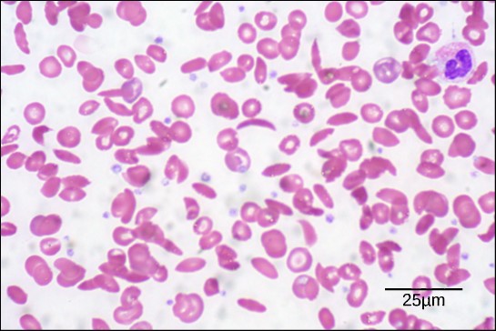 Blood smear