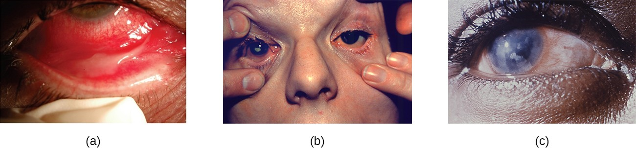 (a) Conjunctivitis is inflammation of the conjunctiva. (b) Blepharitis is inflammation of the eyelids. (c) Keratitis is inflammation of the cornea.