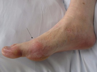 Gout