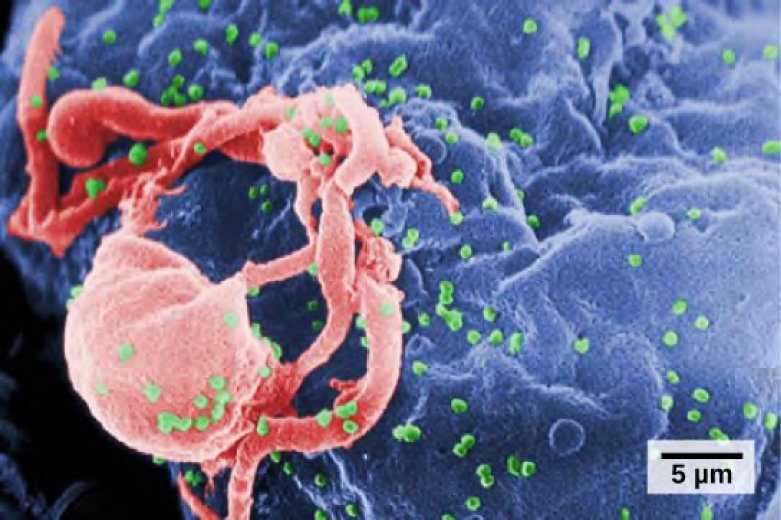 A colored scanning electron micrograph of a lymphocyte with cytoplasmic extensions, and many small spheres coming out of the lymphocyte and scattered around it.
