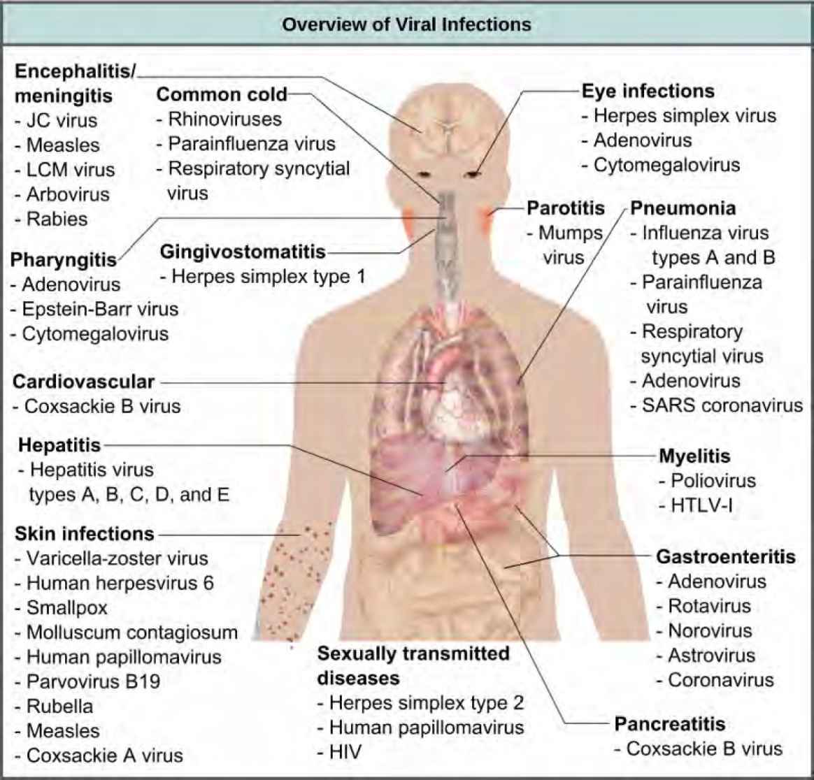 The illustration shows an overview of human viral diseases. Viruses that cause encephalitis or meningitis, or inflammation of the brain and surrounding tissues, include measles, arbovirus, rabies, JC virus, and LCM virus. The common cold is caused by rhinovirus, parainfluenza virus, and respiratory syncytial virus. Eye infections are caused by herpesvirus, adenovirus, and cytomegalovirus. Pharyngitis, or inflammation of the pharynx, is caused by adenovirus, Epstein-Barr virus, and cytomegalovirus. Parotitis, or inflammation of the parotid glands, is caused by mumps virus. Gingivostomatitis, or inflammation of the oral mucosa, is caused by herpes simplex type I virus. Pneumonia is caused by influenza virus types A and B, parainfluenza virus, respiratory syncytial virus, adenovirus, and SARS coronavirus. Cardiovascular problems are caused by coxsackie B virus. Hepatitis is caused by hepatitis virus types A, B, C, D, and E. Myelitis is caused by poliovirus and HLTV-1. Skin infections are caused by varicella-zoster virus, human herpesvirus 6, smallpox, molluscum contagiosum, human papillomavirus, parvovirus B19, rubella, measles, and coxsackie A virus. Gastroenteritis, or digestive disease, is caused by adenovirus, rotavirus, norovirus, astrovirus, and coronavirus. Sexually transmitted diseases are caused by herpes simplex type 2, human papillomavirus, and HIV. Pancreatitis B is caused by coxsackie B virus.