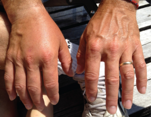 Photo of hands with capillaries