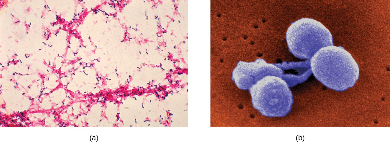 (a) This micrograph of Streptococcus pneumoniae grown from a blood culture shows the characteristic lancet-shaped diplococcal morphology. (b) A colorized scanning electron micrograph of S. pneumoniae.