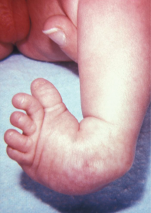Photo of clubfoot