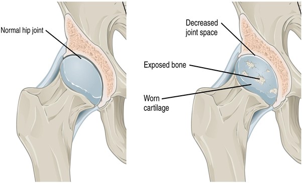 Diagram of Osteoarthritis