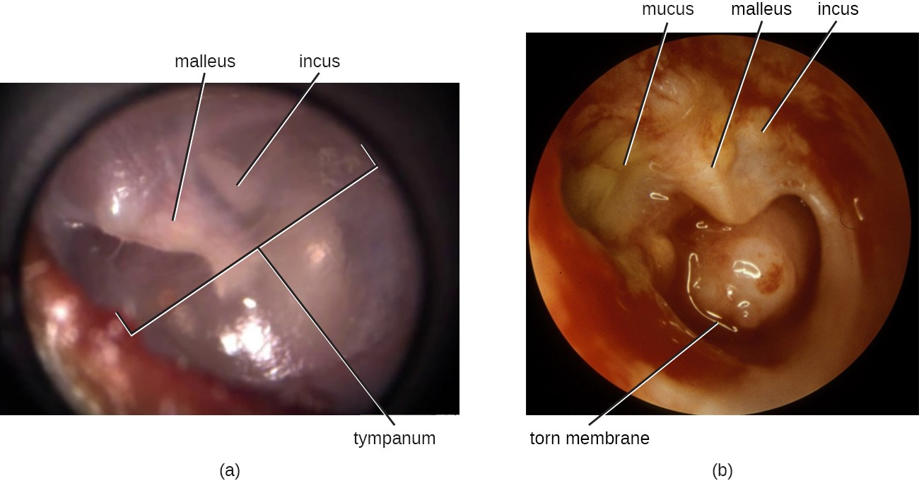 (a) A healthy tympanic membrane; the middle ear bones can be seen behind the membrane. (b) An ear with chronic inflammation that has resulted in a torn membrane, erosion of the inner ear bones, and mucus buildup.