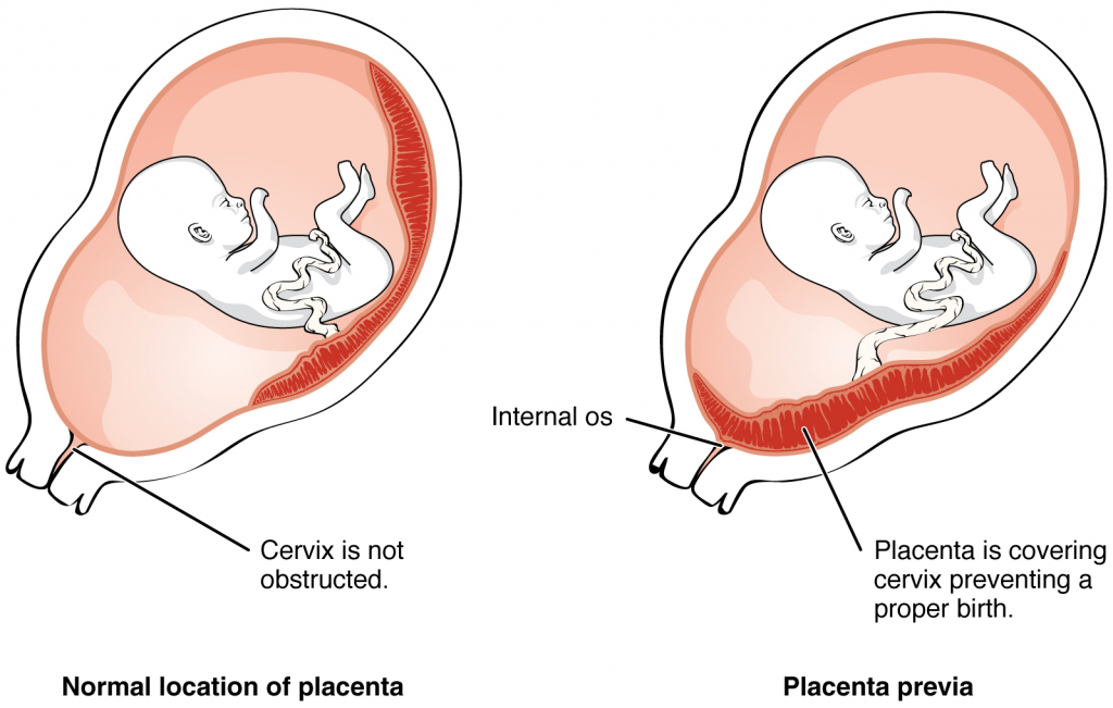 Placenta previa