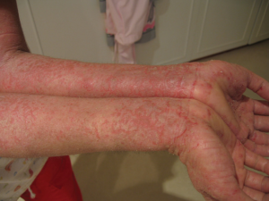 eczema on arms