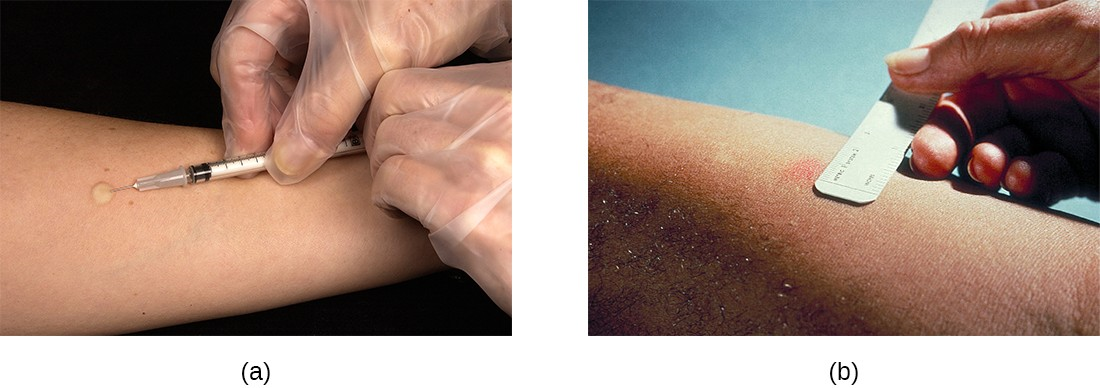 (a) The Mantoux skin test for tuberculosis involves injecting the subject with tuberculin protein derivative. The injection should initially produce a raised wheal. (b) The test should be read in 48–72 hours. A positive result is indicated by redness, swelling, or hardness; the size of the responding region is measured to determine the final result.