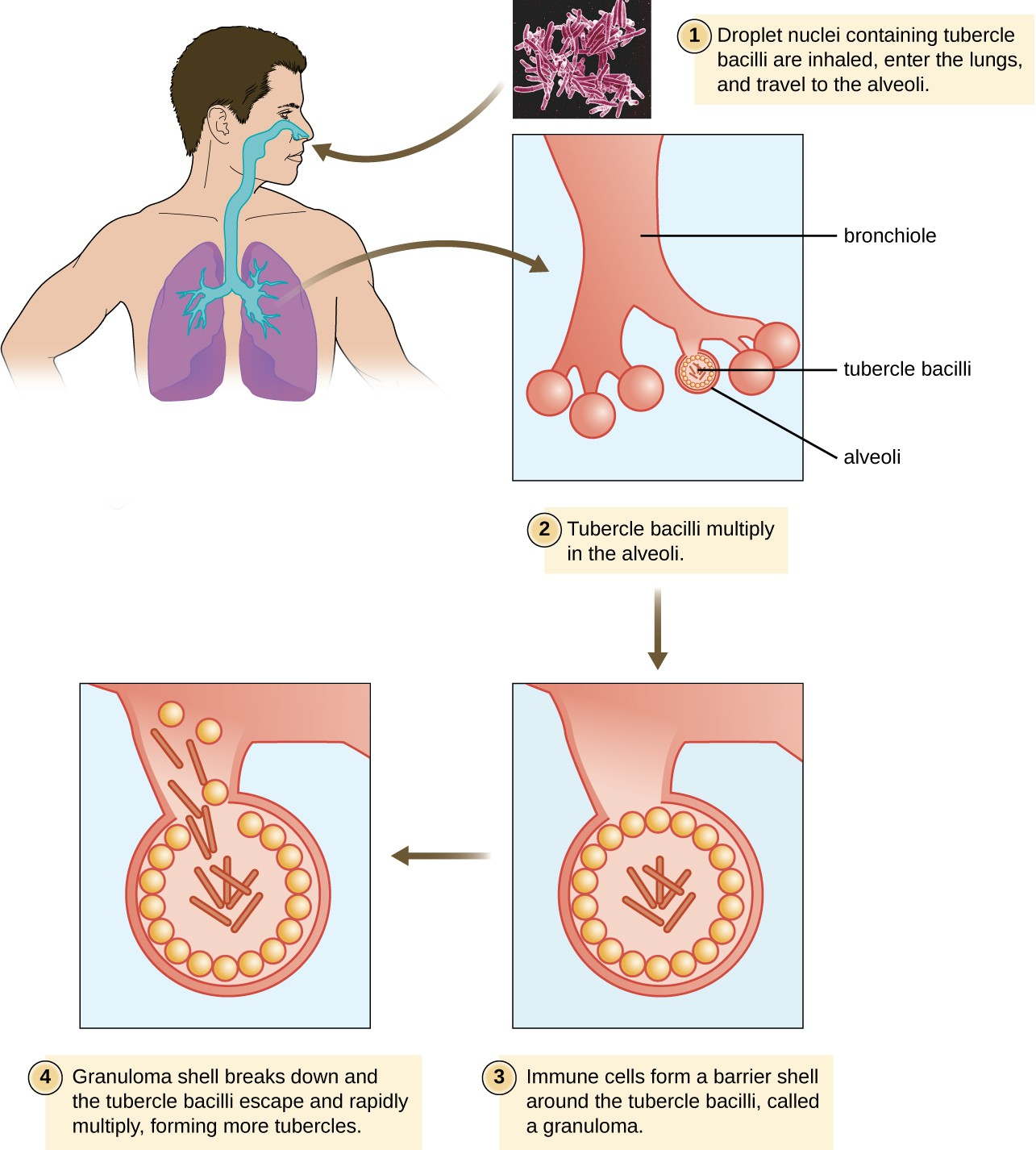 In the infectious cycle of tuberculosis, the immune response of most infected individuals (approximately 90%) results in the formation of tubercles in which the infection is walled off.<a class="footnote" title="G. Kaplan et al. “Mycobacterium tuberculosis Growth at the Cavity Surface: A Microenvironment with Failed Immunity.” Infection and Immunity 71 no.12 (2003):7099–7108." id="return-footnote-410-1" href="#footnote-410-1" aria-label="Footnote 1"><sup class="footnote">[1]</sup></a> The remainder will suffer progressive primary tuberculosis. The sequestered bacteria may be reactivated to form secondary tuberculosis in immunocompromised patients at a later time.