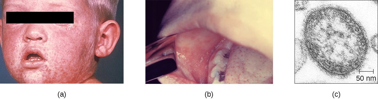 (a) Measles typically presents as a raised macular rash that begins on the face and spreads to the extremities. (b) Koplik’s spots on the oral mucosa are also characteristic of measles. (c) A thin-section transmission electron micrograph of a measles virion.