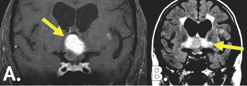 (Left) A white blob is highlighted by a yellow arrow in the center of the figure. It is surrounded by gray colored variations contained within a black and dark gray boarder. (Right) A white colored region resembling an 'X' surrounds a black butterfly-looking structure. The bottom right portion is highlighted by a yellow arrow. It is surrounded by light gray coloration which is contained within a black and white boarder.