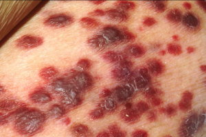 Photo of Kaposi's sarcoma lesions