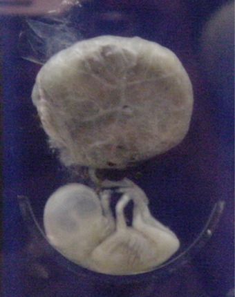 Second trimester