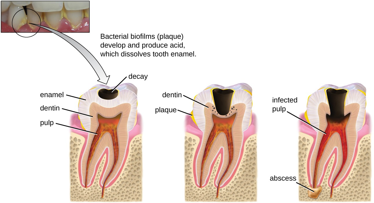 Tooth decay occurs in stages. When bacterial biofilms (plaque) develop on teeth, the acids produced gradually dissolve the enamel, followed by the dentin. Eventually, if left untreated, the lesion may reach the pulp and cause an abscess.
