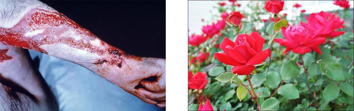 Rose gardener’s disease can occur when the fungus Sporothrix schenkii breaches the skin through small cuts, such as might be inflicted by thorns.