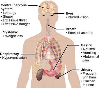 Diabetes mellitus