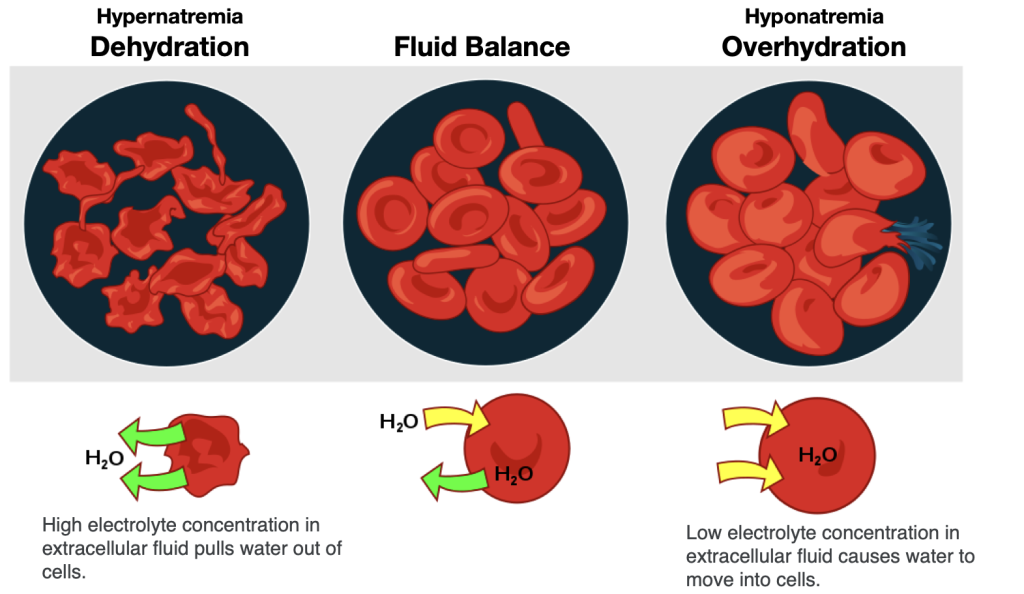 Three different hydration states are shown with the cell. With dehydration, the concentration of electrolytes becomes greater outside of cells, leading to water leaving cells and making them shrink. In fluid balance, electrolyte concentrations are equal inside and outside the cells, so water is in balance, too. During overhydration, electrolyte concentrations are low outside the cell relative to inside the cell (like in the situation of hyponatremia), so water moves into the cells, making them swell.