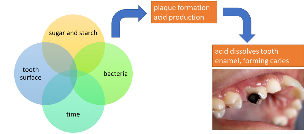 The image is a schematic. On the left, it shows a Venn diagram with four circles coming together, with the words "tooth surface," "sugar and starch," "bacteria," and "time." When these 4 factors are present, the schematic shows that it results in plaque formation and acid production. This then leads to acid dissolving tooth enamel, forming dental caries. A photo shows a tooth with a severe cavity, with half of the tooth blackened.