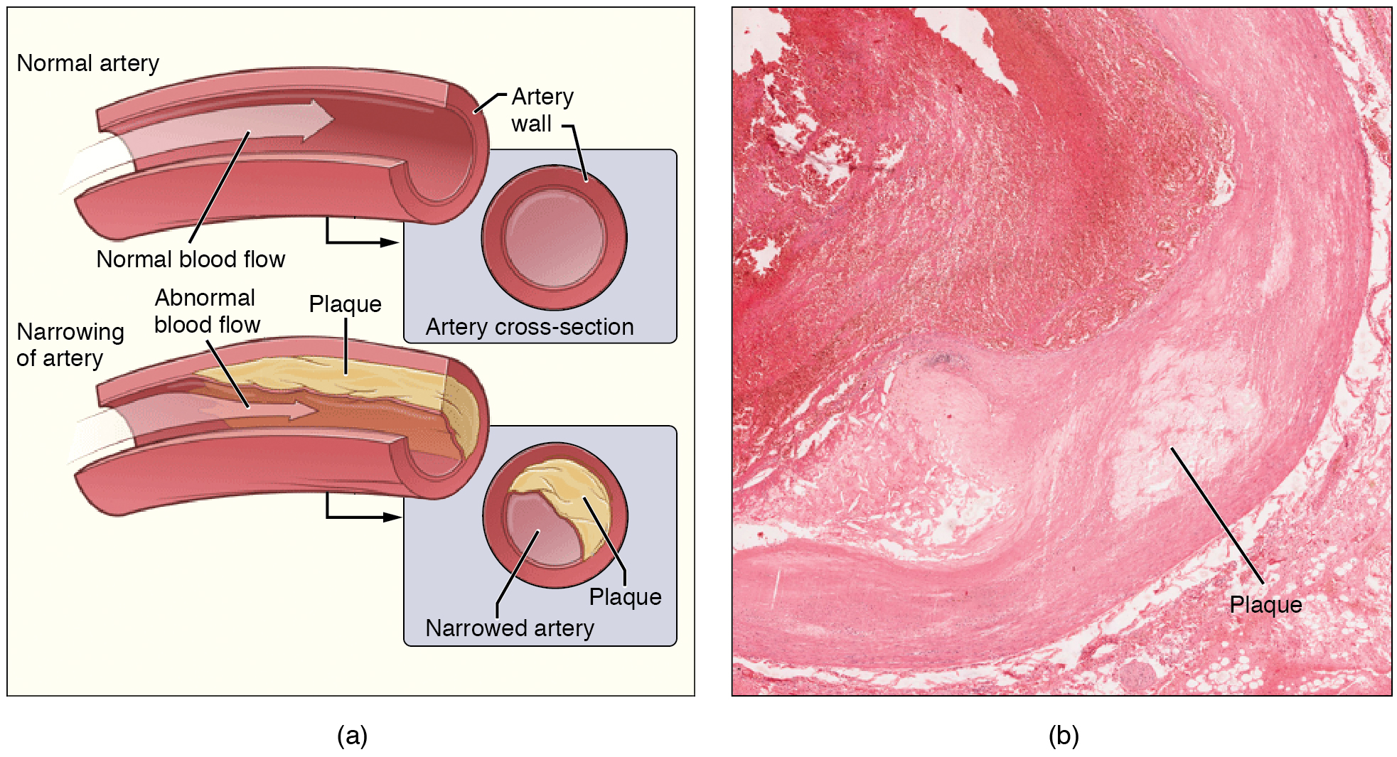 Normal and narrowing arteries. Image description available.