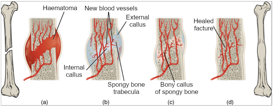 Diagram of stages in fracture repair