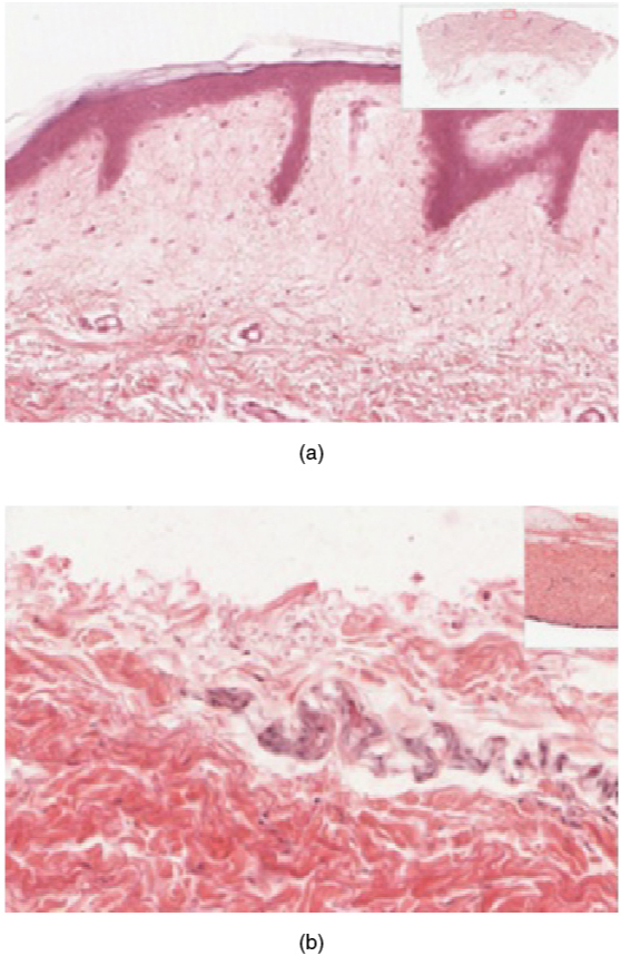 Image of thin skin and thick skin