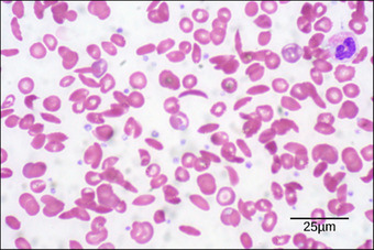 Sickle cell anemia