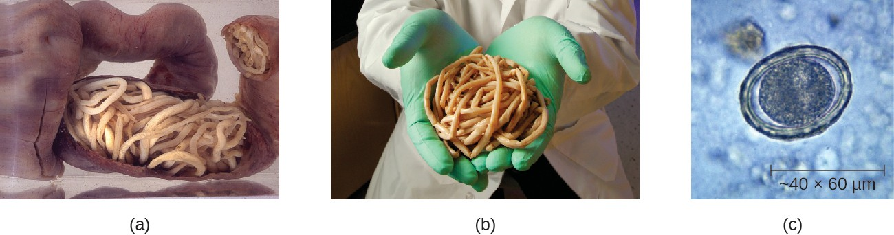 (a) Adult Ascaris lumbricoides roundworms can cause intestinal blockage. (b) This mass of A. lumbricoides worms was excreted by a child. (c) A micrograph of a fertilized egg of A. lumbricoides. Fertilized eggs can be distinguished from unfertilized eggs because they are round rather than elongated and have a thicker cell wall.