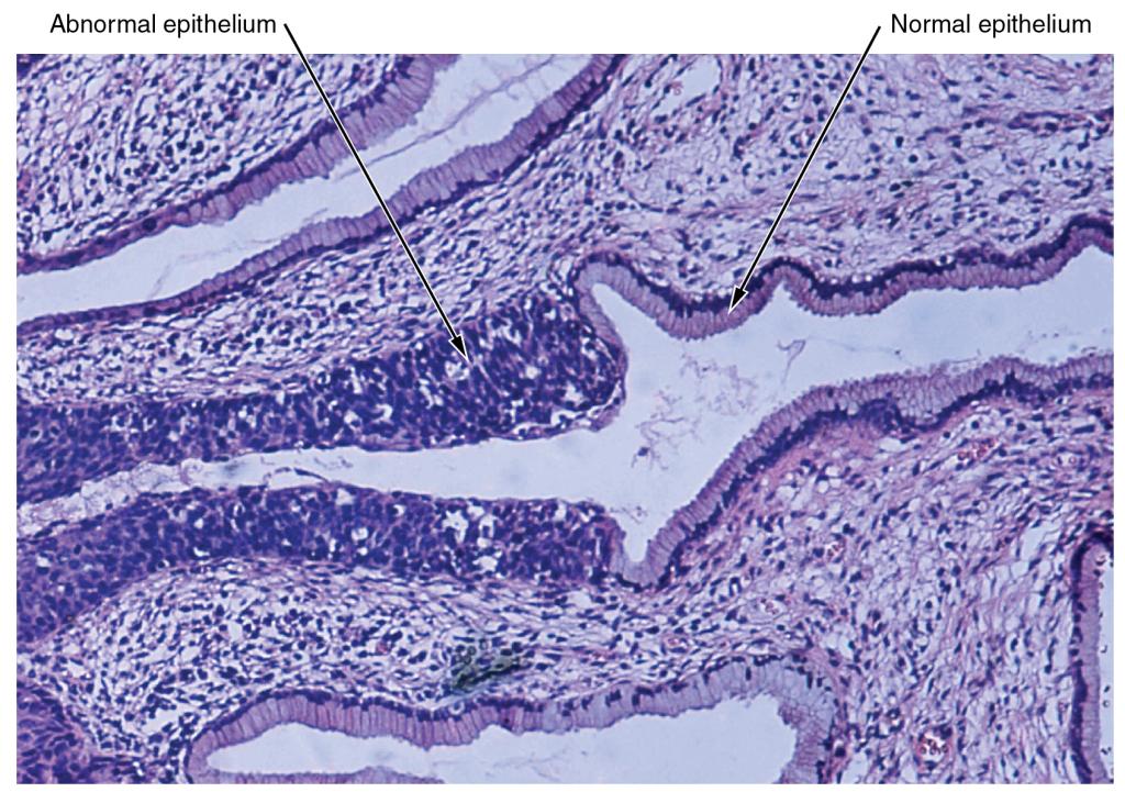 This micrograph shows tissue surrounding several empty spaces. The epithelial tissue occurs at the border between the rest of the tissue and the empty spaces. The normal epithelium is composed of rectangular-shaped cells neatly organized side by side. Dark purple nuclei are clear at the bottom of the epithelial cells, where they attach to the rest of the tissue. The abnormal epithelium appears as a tangled area of purple nuclei, much thicker than the normal epithelium although no distinct cells are discernible.