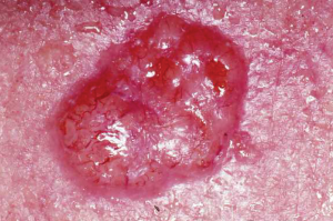 Image of Basal cell carcinoma