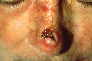 Lesion on person's nose