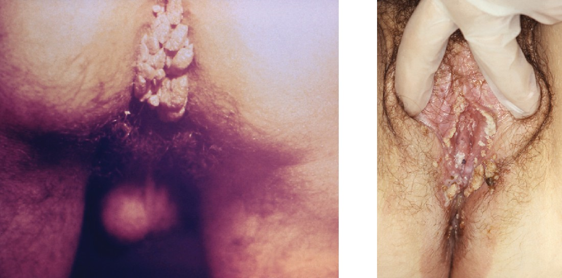 Genital warts may occur around the anus (left) or genitalia (right).