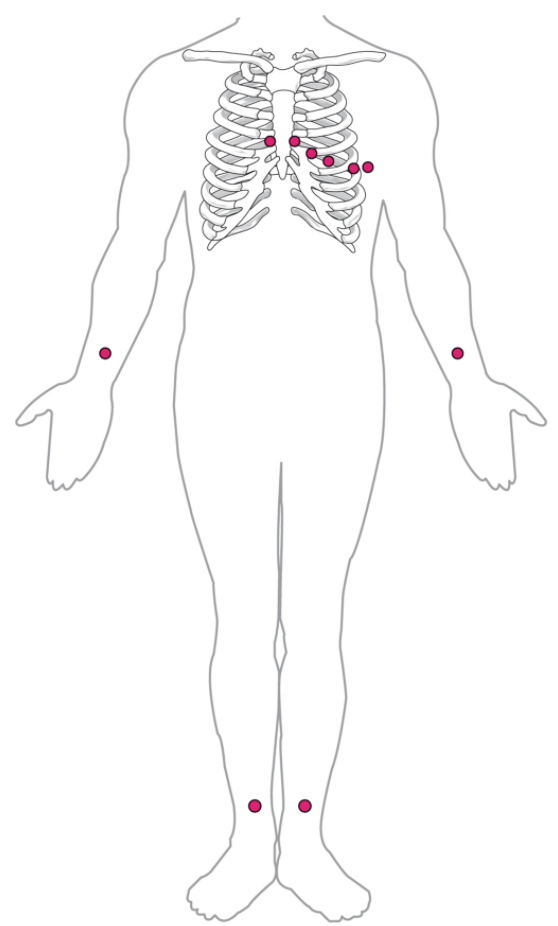 Standard placement of ECG leads.