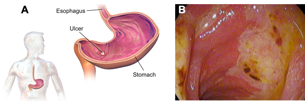 At left is a cartoon showing a profile of a person's torso, with the stomach and esophagus highlighted. Next to it is a larger version of the drawing of a stomach, with a yellow-colored ulcer shown on the stomach's lining. At right is an image from an endoscopy, showing the lining of the duodenum with abnormal lesions that are yellow, white, and brown in color compared to the normal pink tissue around it.