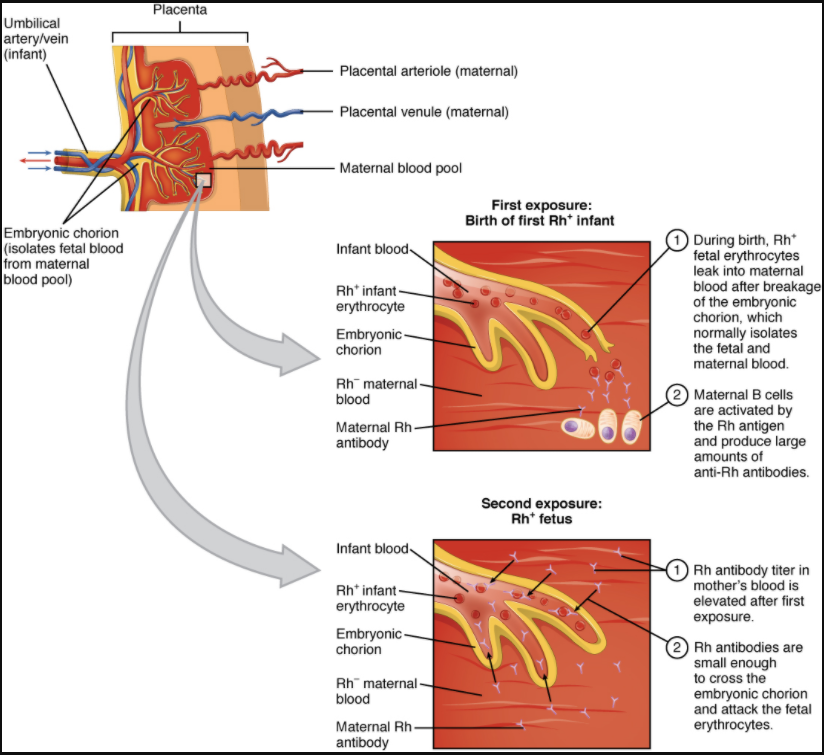 Diagram of Erythroblastosis fetalis