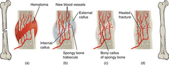 Stages of fracture repair