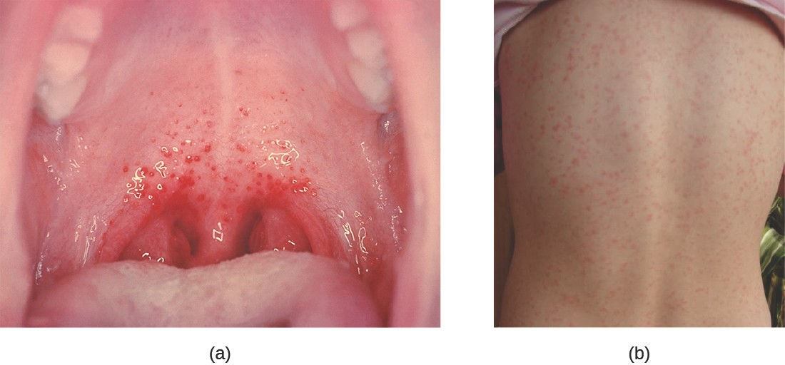 Streptococcal infections of the respiratory tract may cause localized pharyngitis or systemic signs and symptoms. (a) The characteristic appearance of strep throat: bright red arches of inflammation with the presence of dark-red spots (petechiae). (b) Scarlet fever presents as a rash on the skin.