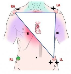 Leads I, II, and III.