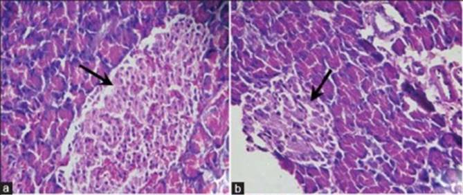 Micrograph showing a large islet of pancreas from a control normal rat on the left and a diabetic rat on the right